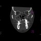 Fracture of facial skeleton, Le Fort III: CT - Computed tomography